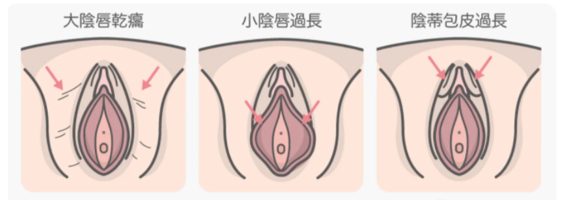 私密處構造：左邊大陰唇乾扁、中間小陰唇過長、右邊陰蒂包皮過長。