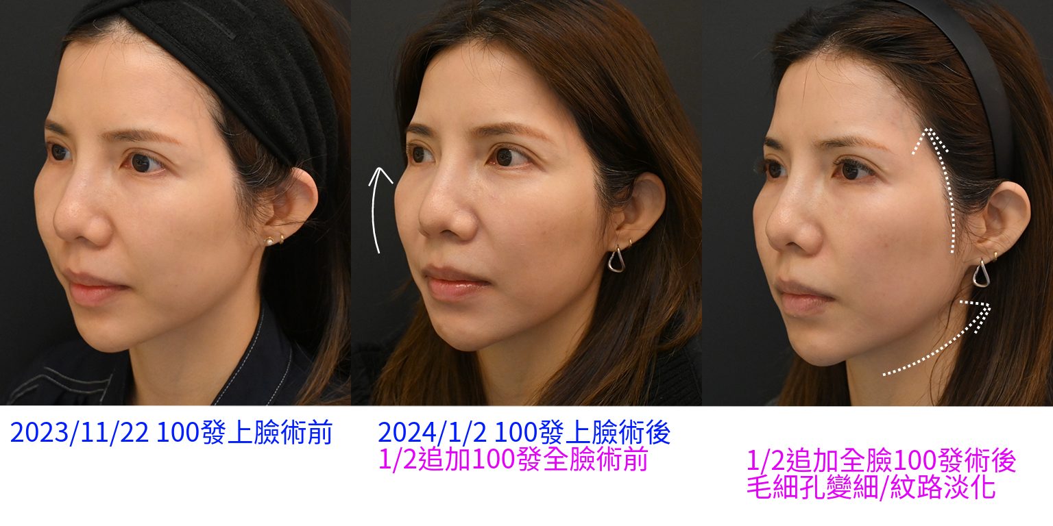 施打索夫波2個月的變化，明顯看見臉部拉提以及緊緻和毛細孔縮小的效果。